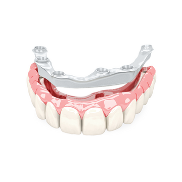 Zirconia Full Arch with Implant Titanium Bar